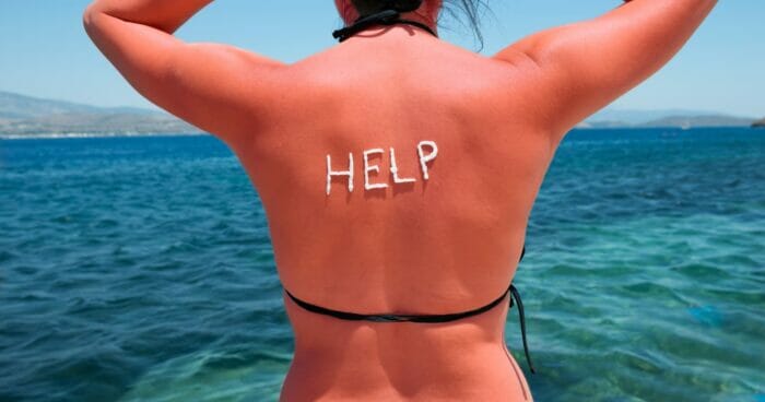 Woman with sunburn on her back asking for help